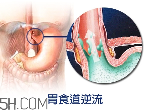 胃食道逆流怎么辦 質(zhì)子泵抑制劑風(fēng)險高