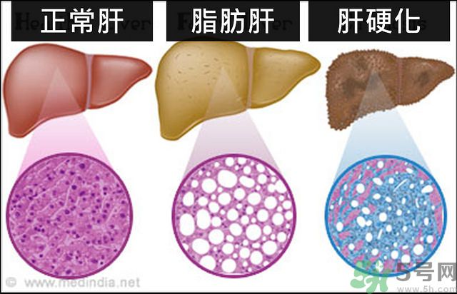 得了脂肪肝該怎么治？脂肪肝對人體危害有多大？