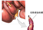 闌尾手術(shù)會影響結(jié)腸嗎？闌尾手術(shù)術(shù)后要注意什么？