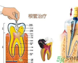 什么是根管治療？為什么牙齒疼要做根管治療？