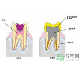 什么是根管治療？為什么牙齒疼要做根管治療？