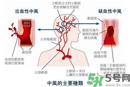 腦中風(fēng)是什么？腦中風(fēng)的癥狀？