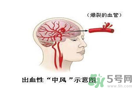 腦中風(fēng)的護(hù)理措施？腦中風(fēng)的飲食護(hù)理？