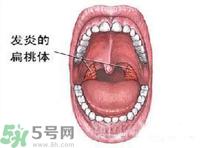 慢性咽炎是什么？慢性咽炎的癥狀有哪些？