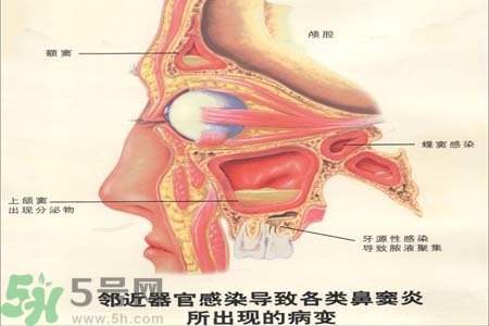 鼻竇炎是什么？鼻竇炎的癥狀有哪些？