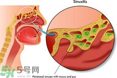鼻竇炎的護(hù)理措施？鼻竇炎的飲食護(hù)理？