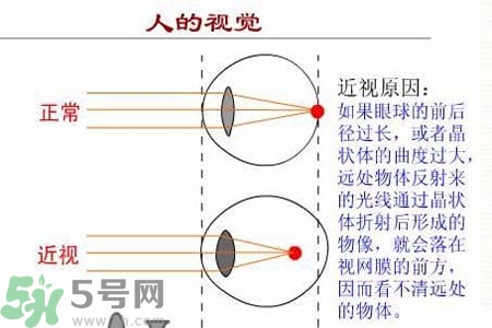 近視眼的發(fā)病因素？近視眼的并發(fā)癥有哪些？