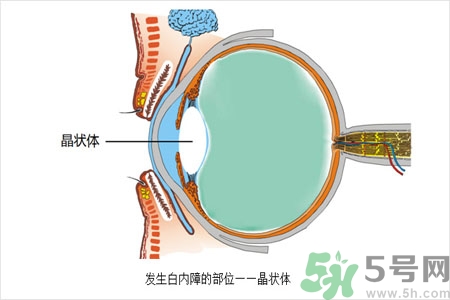 白內(nèi)障的護(hù)理措施是什么？白內(nèi)障的飲食護(hù)理有哪些？