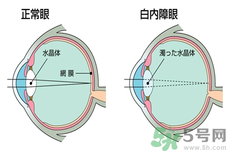 白內(nèi)障的發(fā)病因素是什么？白內(nèi)障并發(fā)癥有哪些？