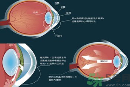 青光眼是什么？青光眼癥狀有什么？