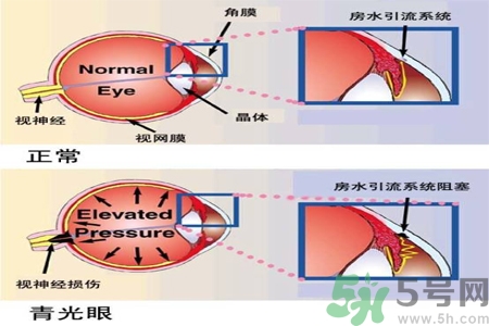 青光眼的護理措施有什么？青光眼的飲食護理有哪些？