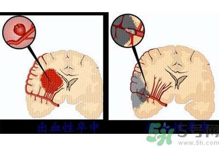 腦出血的發(fā)病因素是什么？腦出血的并發(fā)癥有哪些？