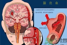 腦出血的發(fā)病因素是什么？腦出血的并發(fā)癥有哪些？