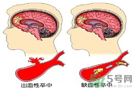 腦出血的治療方法是什么？腦出血可以用哪些藥物治療？