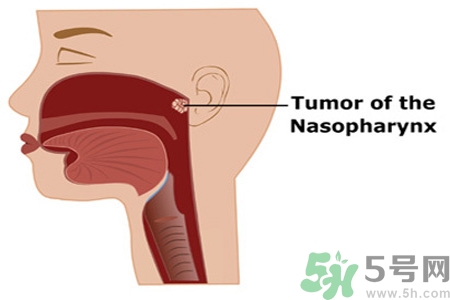 鼻咽癌的日常措施是什么？鼻咽癌注意的飲食有哪些？