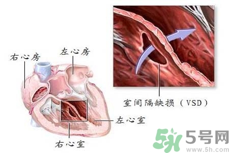 先天性心臟病是什么？先天性心臟病的癥狀有哪些？