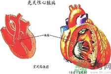 先天性心臟病發(fā)病原因是什么？