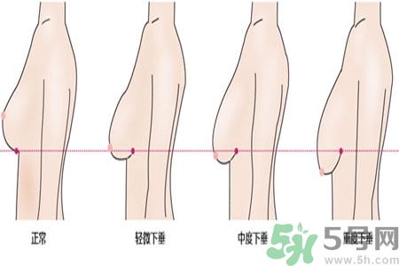 ?女性乳房下垂的原因是什么？女性乳房下垂的分類有哪些？