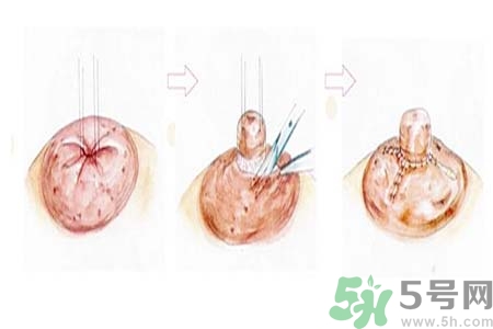 乳頭內(nèi)陷怎么回事？乳頭內(nèi)陷的原因是什么？