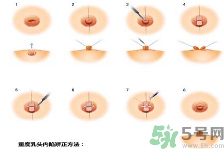 乳頭內(nèi)陷怎么回事？乳頭內(nèi)陷的原因是什么？