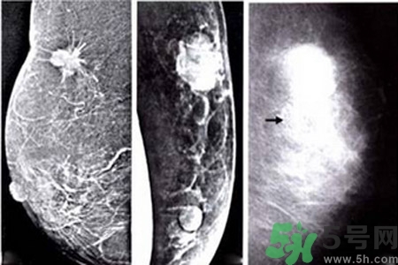產(chǎn)生乳腺增生鈣化的病因是什么？乳腺增生怎樣治療？