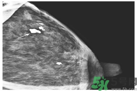 產(chǎn)生乳腺增生鈣化的病因是什么？乳腺增生怎樣治療？