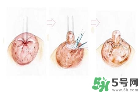 乳頭內(nèi)陷怎么矯正？乳頭內(nèi)陷矯正方法是什么？