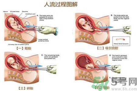 人工流產(chǎn)后多久可以再次懷孕？流產(chǎn)后需要注意什么？