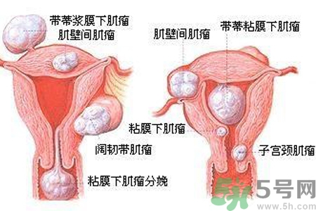 ?子宮移位怎么治療？子宮移位能懷孕嗎？