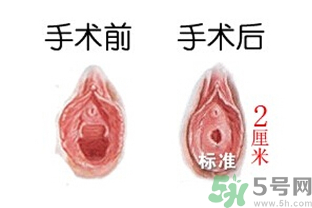 什么人不能做處女膜修補術(shù)？處女膜修補術(shù)會留疤嗎？