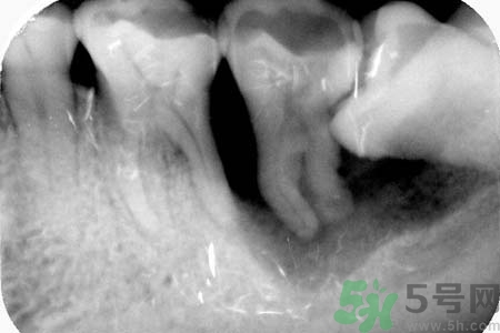 拔智齒一顆多少錢？拔除智齒收費(fèi)多少？