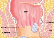 怎樣辨別外痔和內(nèi)痔？外痔和內(nèi)痔的區(qū)別