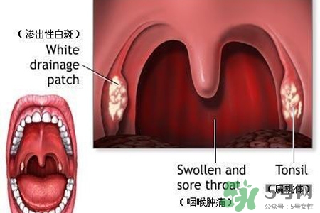 咽喉炎吃什么藥最好？咽喉炎吃什么藥好的快？