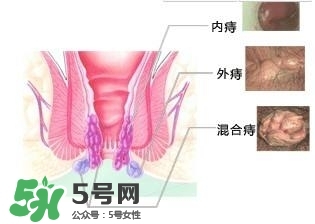 痔瘡吃什么藥效果好？痔瘡吃什么藥好得快？