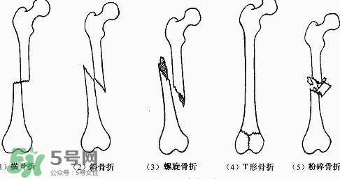 骨折吃什么好得快？骨折后注意事項(xiàng)