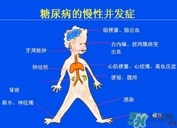 糖尿病癥狀 糖尿病早期癥狀