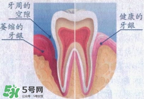 牙齦萎縮怎么辦？牙齦萎縮癥狀