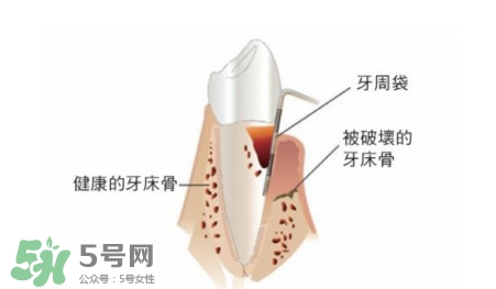 牙周炎怎么治療？牙周炎怎么治好