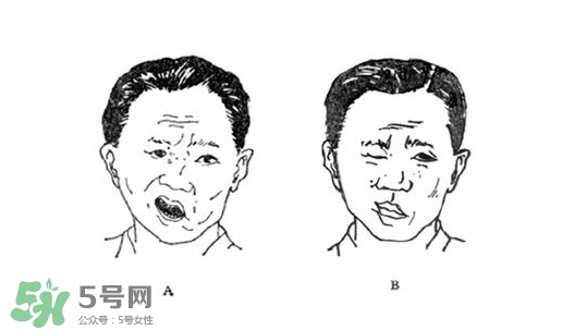 面癱是什么導致的？面癱多久徹底恢復正常