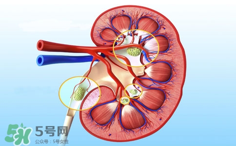 腎結(jié)石有什么癥狀？腎結(jié)石原因