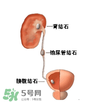 腎結(jié)石有什么癥狀？腎結(jié)石原因