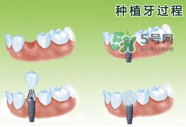 種植牙費(fèi)用多少錢？國產(chǎn)種植牙價(jià)格