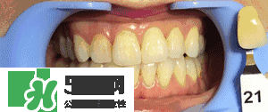 牙齒美白的方法有那些 牙齒美白心得