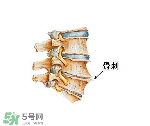 骨刺是怎么形成的？骨刺怎么治療？