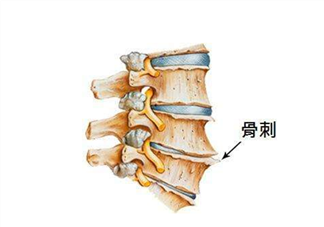 骨刺是怎么形成的？骨刺怎么治療？