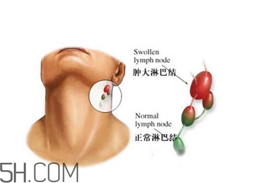 淋巴癌能活多久？淋巴癌癥狀有哪些