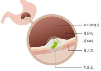 幽門螺桿菌的癥狀有哪些表現(xiàn)？幽門螺旋菌怎么治療