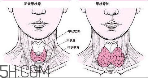 甲狀腺結(jié)節(jié)與甲狀腺腫瘤的區(qū)別有哪些？甲狀腺結(jié)節(jié)可以艾灸嗎