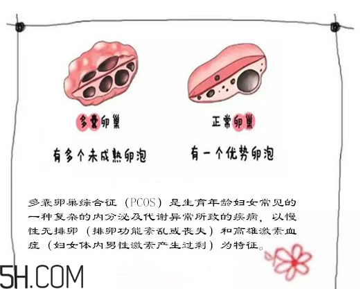 多囊卵巢生不了？多囊卵巢懷孕要看準時間