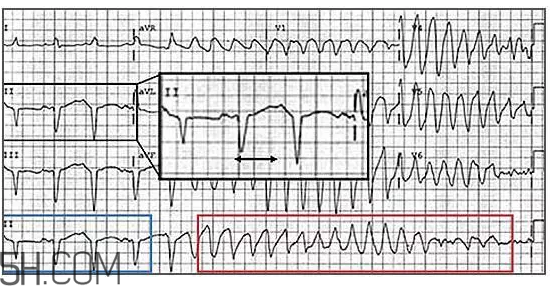 心電圖怎么看？6種常見心電圖異常情況